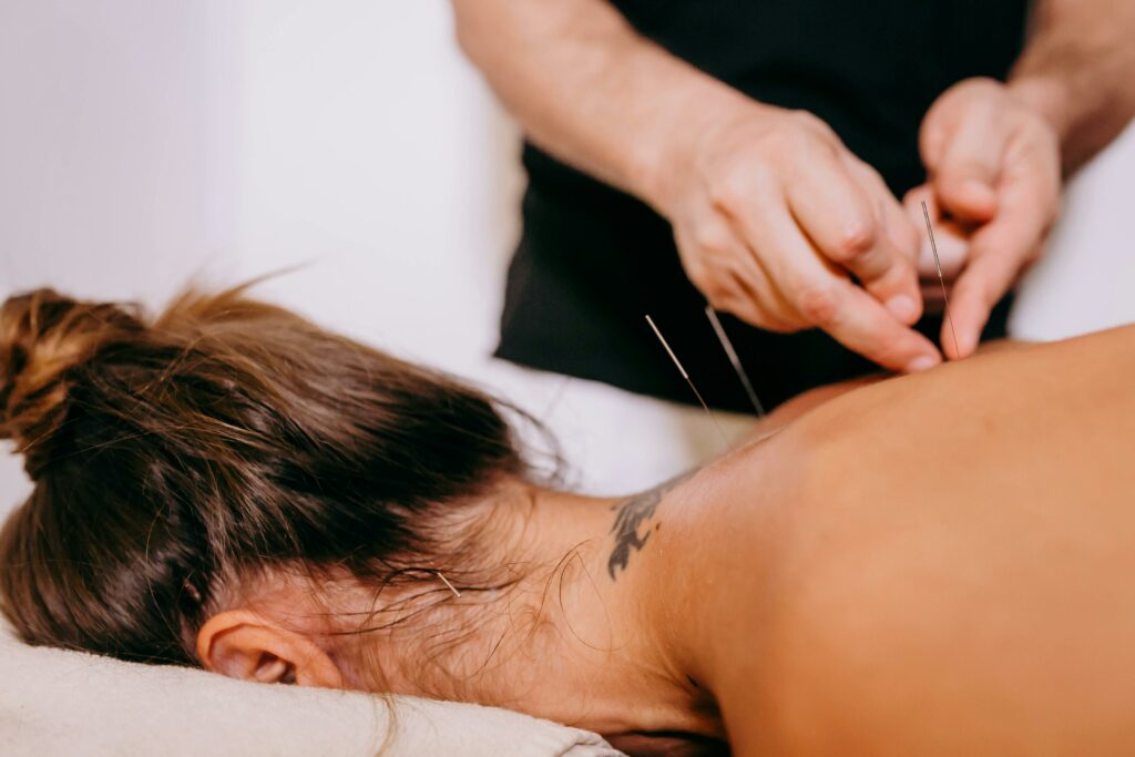 Close-up of acupuncture needles being inserted on a woman's back during therapy, promoting relaxation and wellness.